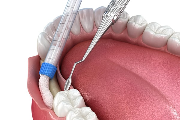 Bone Grafting illustration